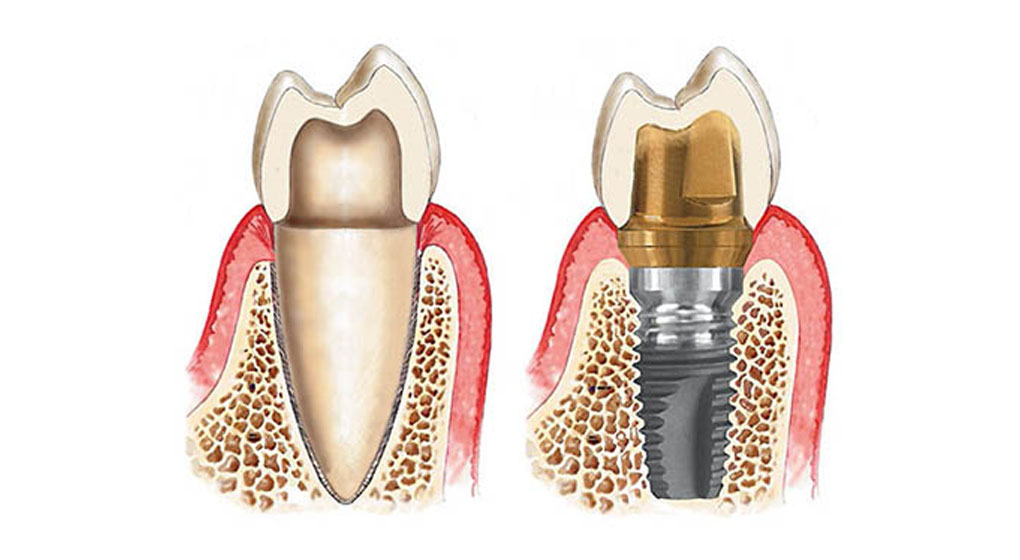 天然歯に近い見た目と機能を取り戻せる治療