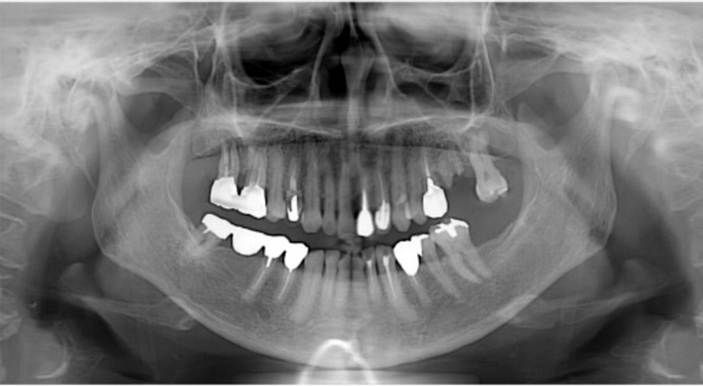 お口の全体を写すレントゲン撮影