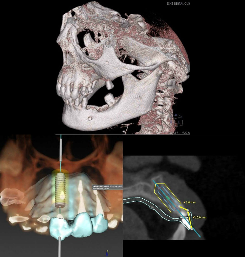 CT撮影による3次元的な骨の状態の把握