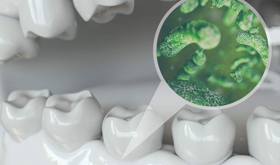 歯垢と歯石は歯周病菌の温床